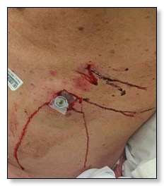 The side wound.